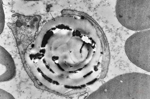 M,43y. | blood - degraded Candida (bone marrow suppression) M,43y. | blood - degraded Candida (bone marrow suppression)